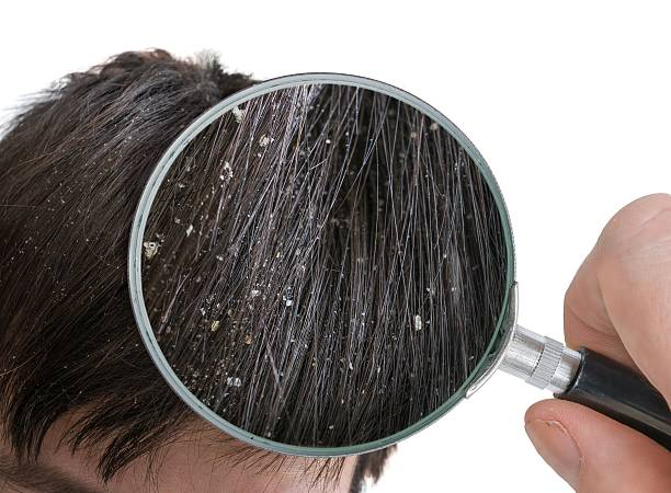 Hairloss due to dandruff : Dandruff से परेशान , बालों की रूसी से झड़ रहे हैं बाल, सिर में जम जाती हैं परत, जानते हैं रामबाण इलाज